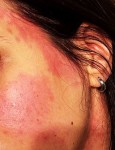  Nietolerancja histaminy - polimorfizmy DAO (gen AOC1)